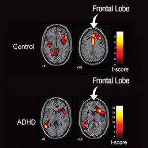 ADHD brain scan